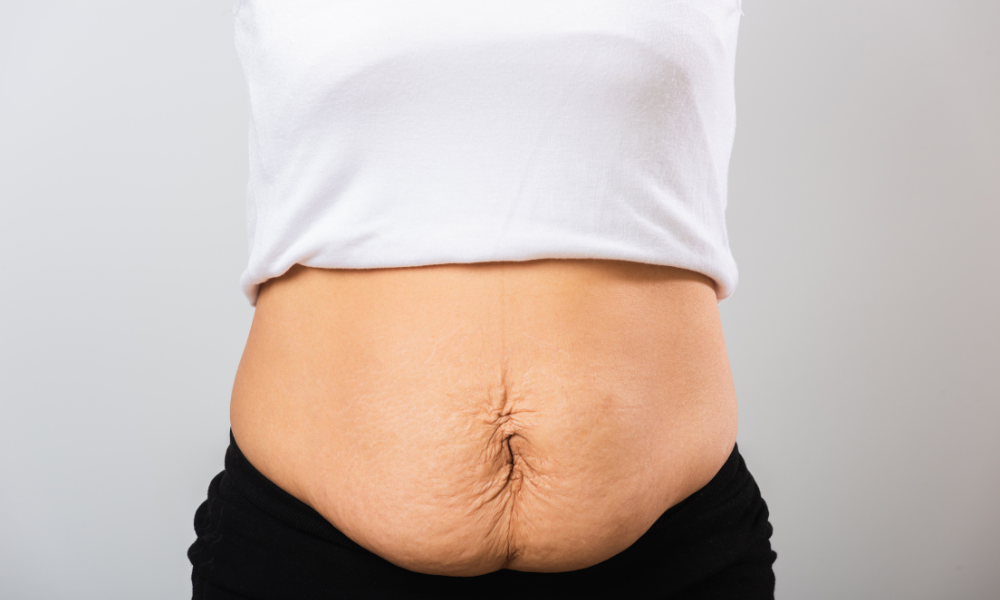 Como saber se tenho diástase abdominal?
